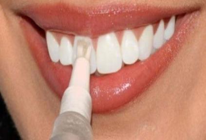 طريقة برد الاسنان في البيت